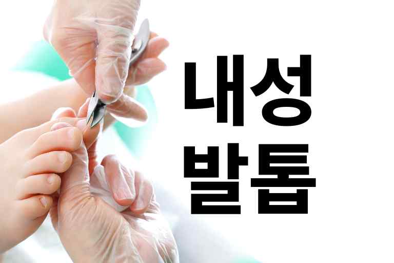 내성발톱 수술 비용 0만원, 원인과 예방법