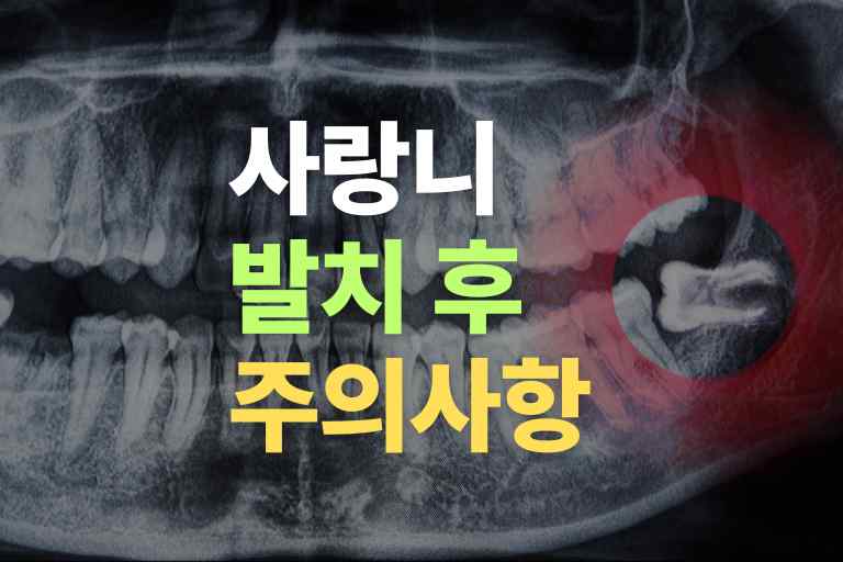 사랑니 발치 후 누워도 되나요, 주의사항 17가지